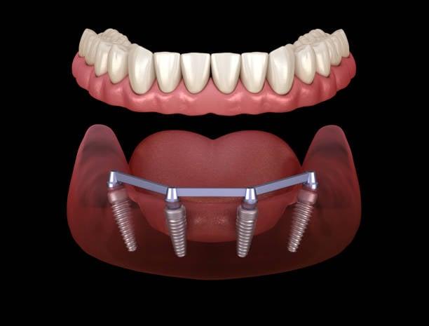 What Are Dental Implants and How Do They Work?