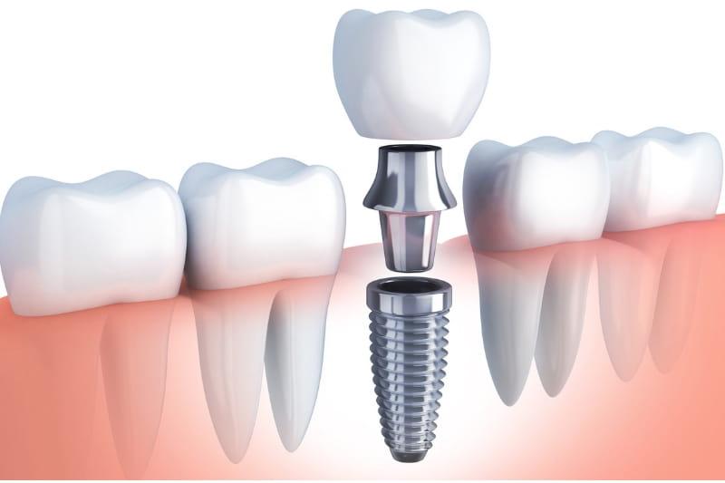The Dental Implant Procedure: Step-by-Step Guide