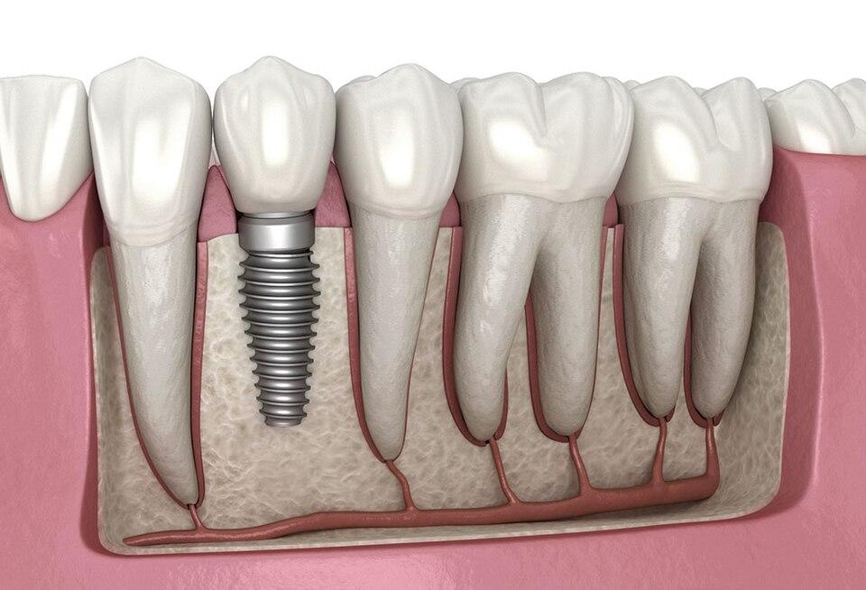 Top 5 Benefits of Getting Dental Implants