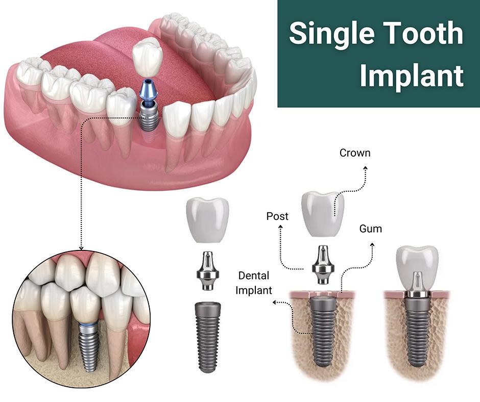 How Long Do Dental Implants Last?