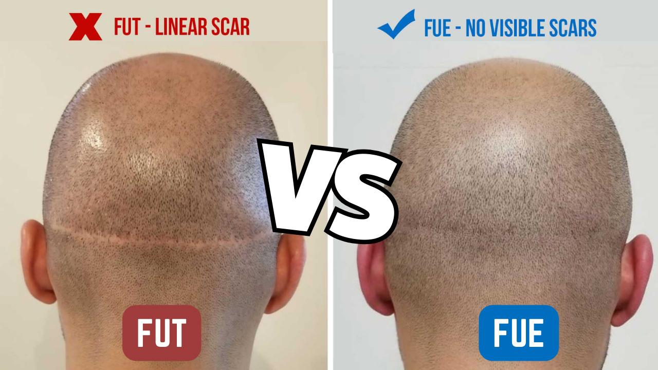 FUE vs. FUT Hair Transplants: Which One Is Right for You?