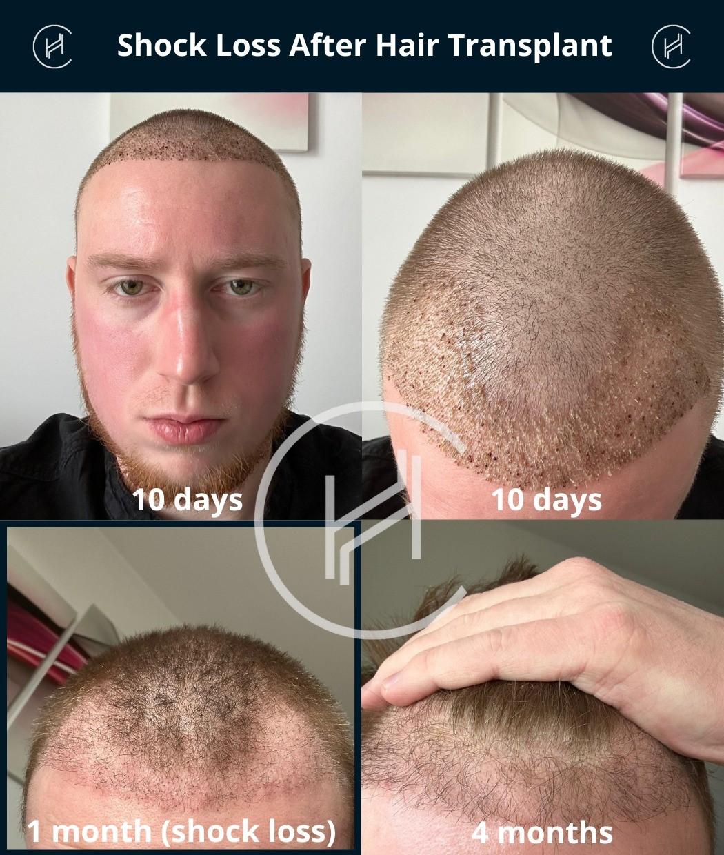 Turkey vs. USA: Where Should You Get Your Hair Transplant?