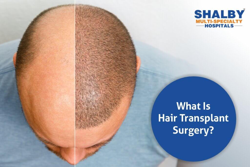Hair Transplant 101: Everything You Need to Know Before Going Under the Needle