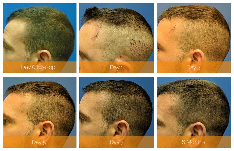 Hair Transplant Recovery Timeline: What to Expect Week by Week