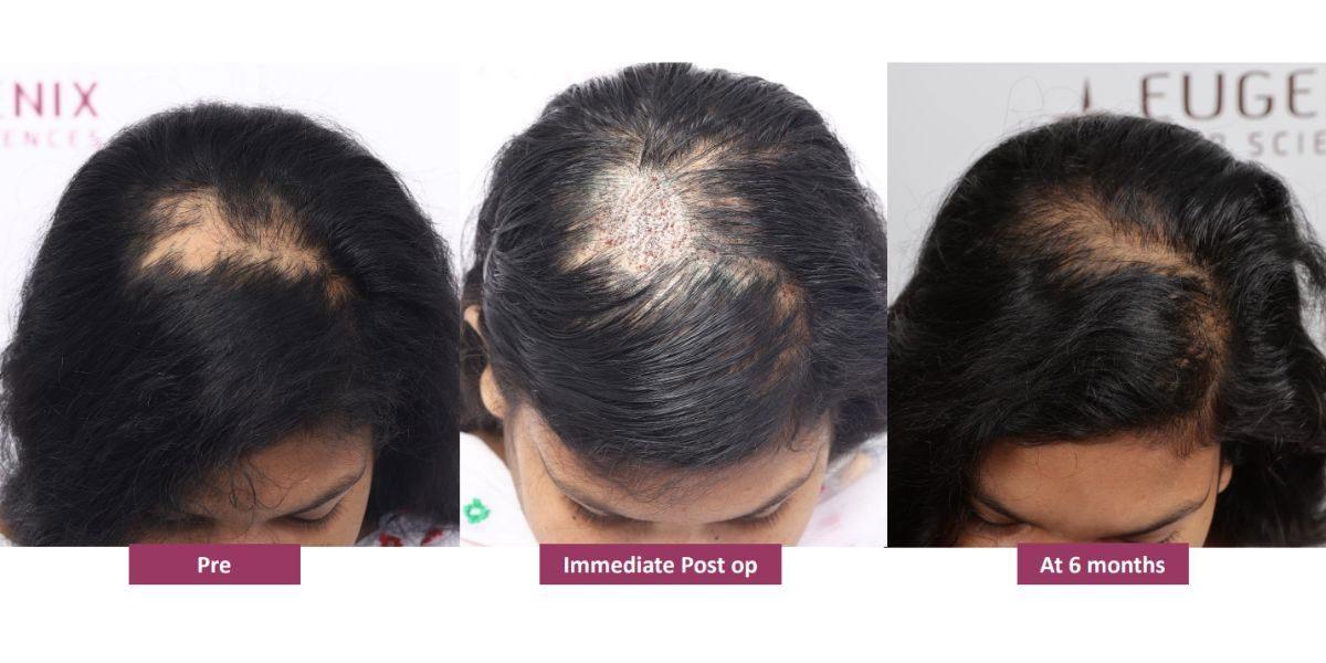 The Ultimate Guide to Hair Restoration for Men and Women