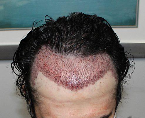 Is a Hair Transplant Permanent? What Science Says