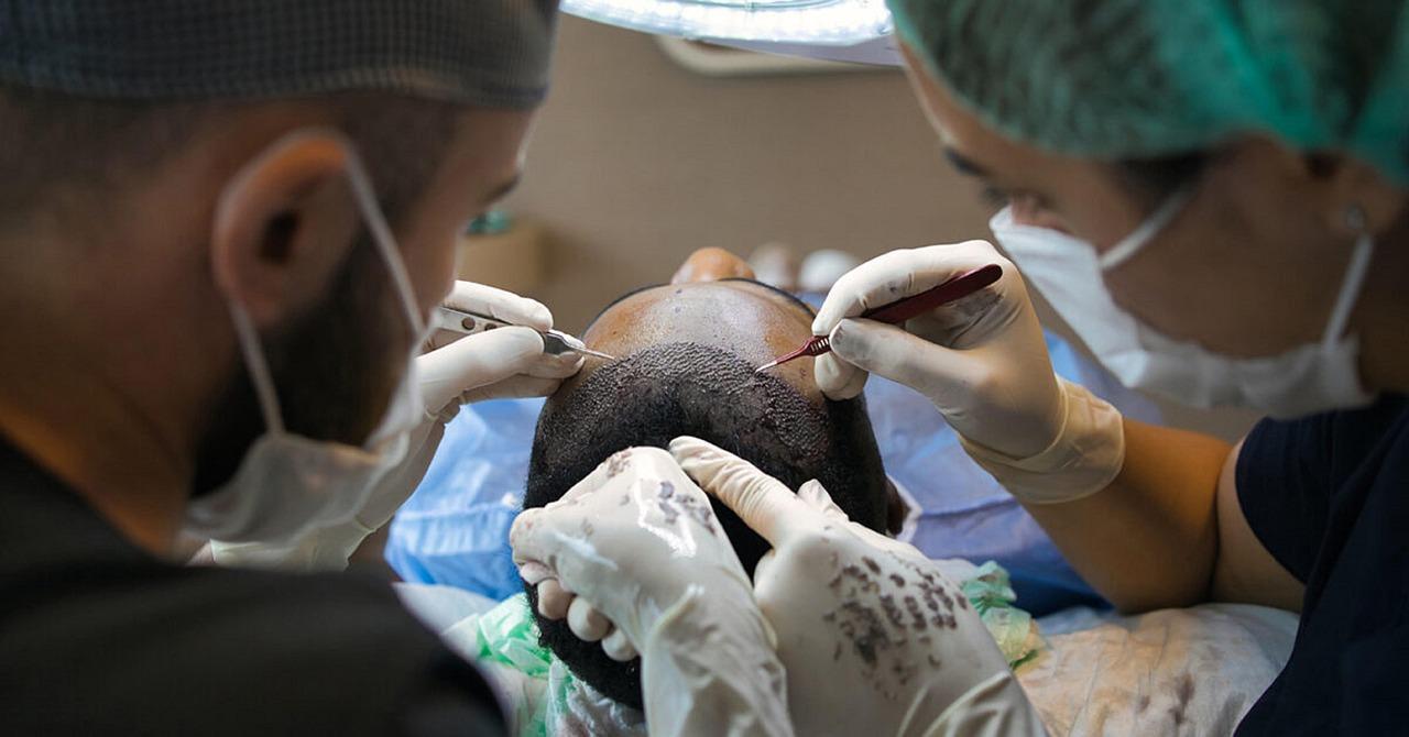 understanding Hair Transplants and Their Longevity