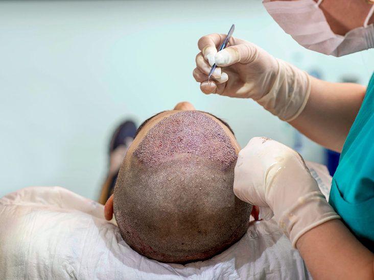 Understanding the Initial Healing Phase​ After Hair ​Transplant Surgery