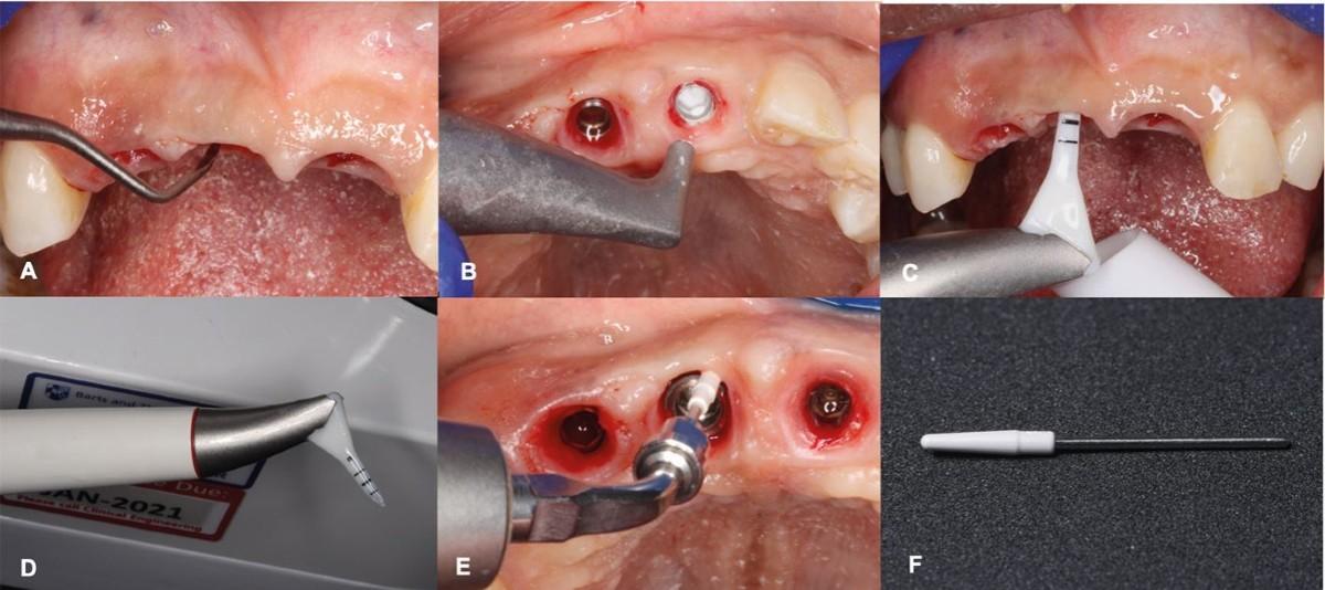 Understanding⁣ the Importance of​ Dental Implant Maintenance