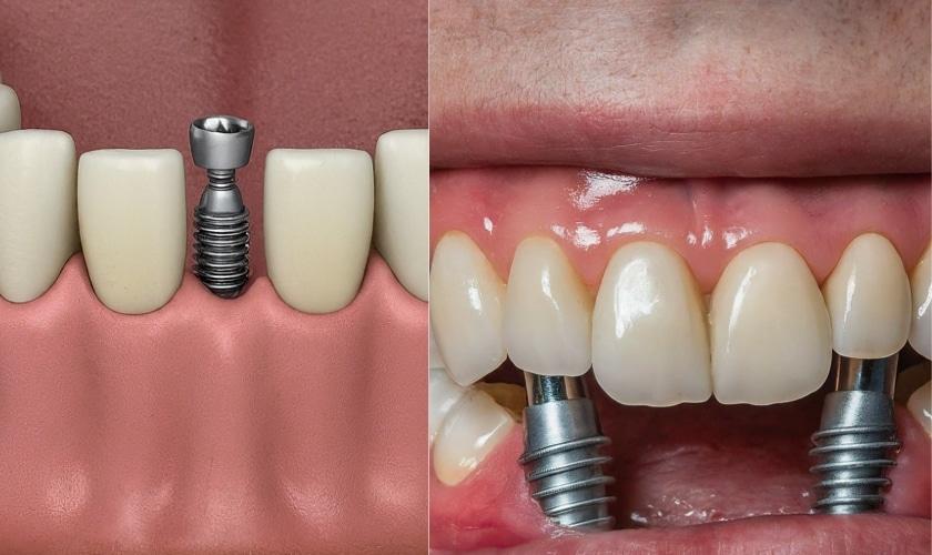 Exploring Financing Options‌ and Insurance​ Coverage for ‍Dental Implants