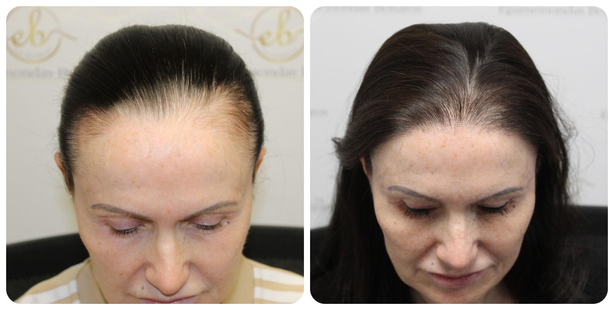 Expert Insights on the Realities ⁢of Hair Restoration Procedures