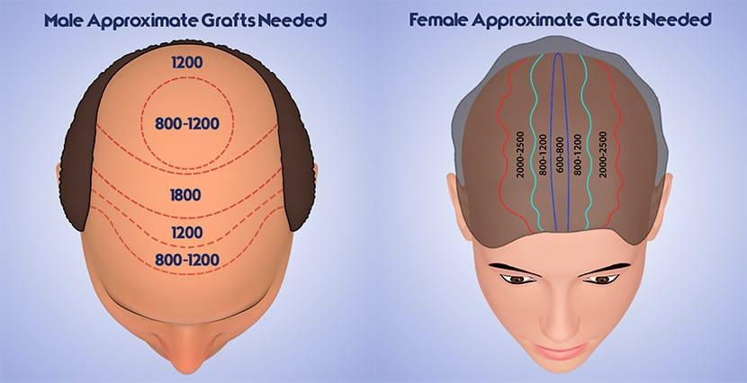 Hidden Expenses in Hair Restoration: What to Budget For