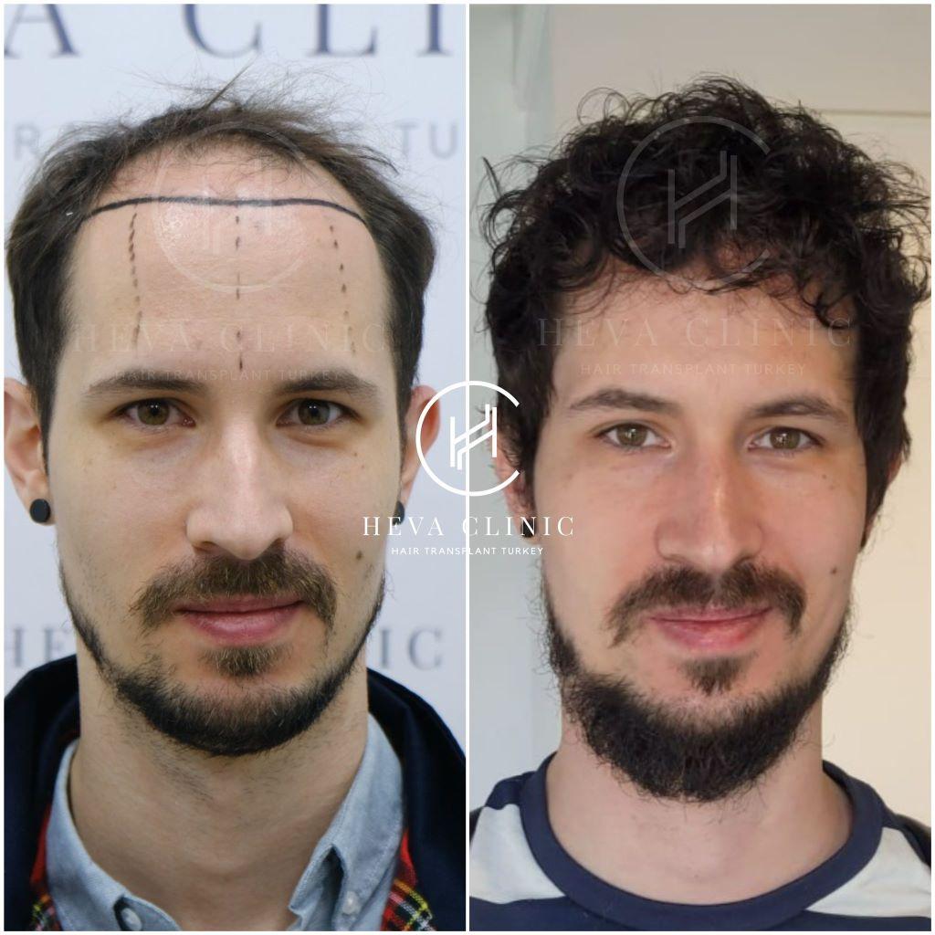 Understanding the ⁤Hair Transplant Process and Its Benefits