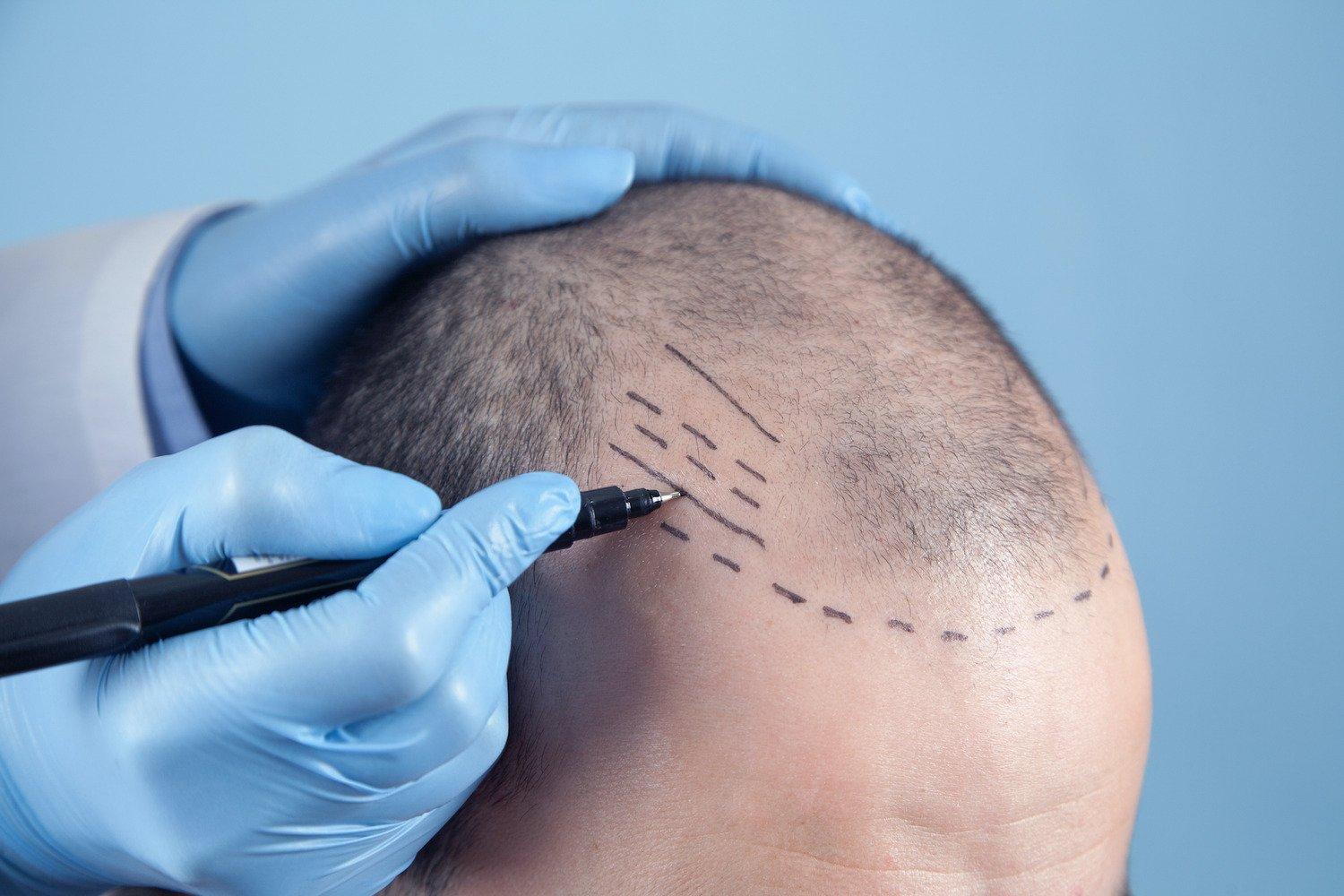 Practical ​Recommendations for Choosing the ‌Right Hair Transplant Specialist