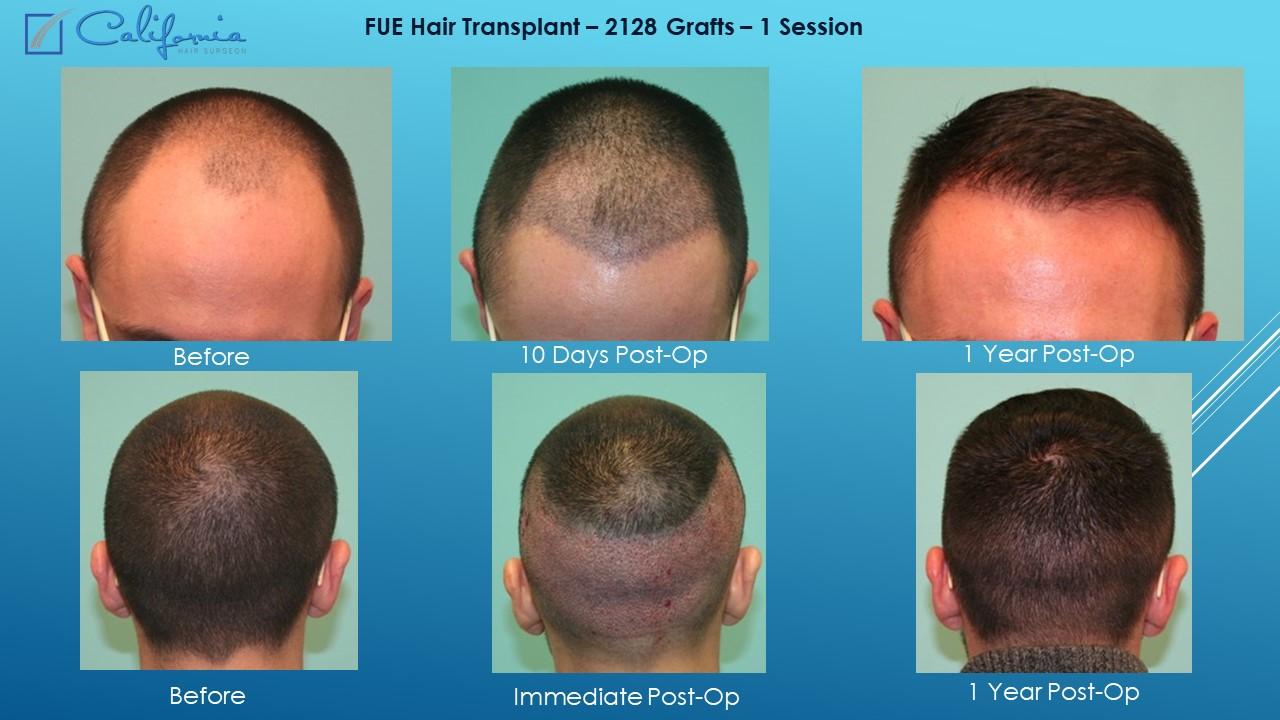 understanding the basics of ⁢FUE and ⁣FUT⁣ Hair Transplants