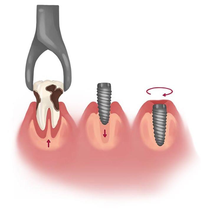 the Implant ‌Placement Process: What ‌to Expect During Surgery