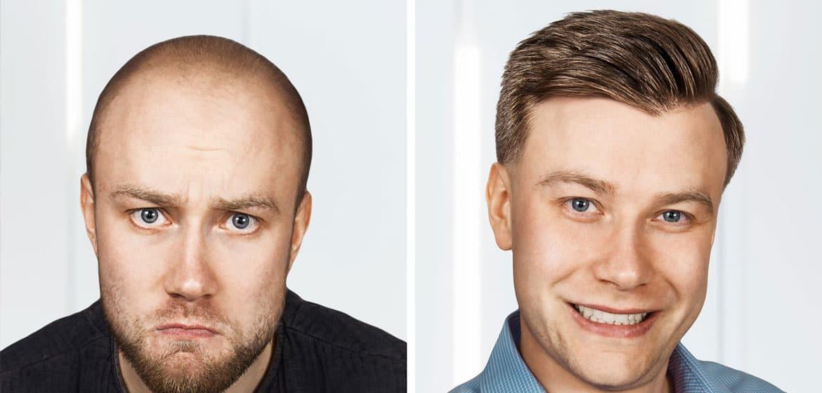 Best Practices for Maximizing Hair‌ Transplant Success