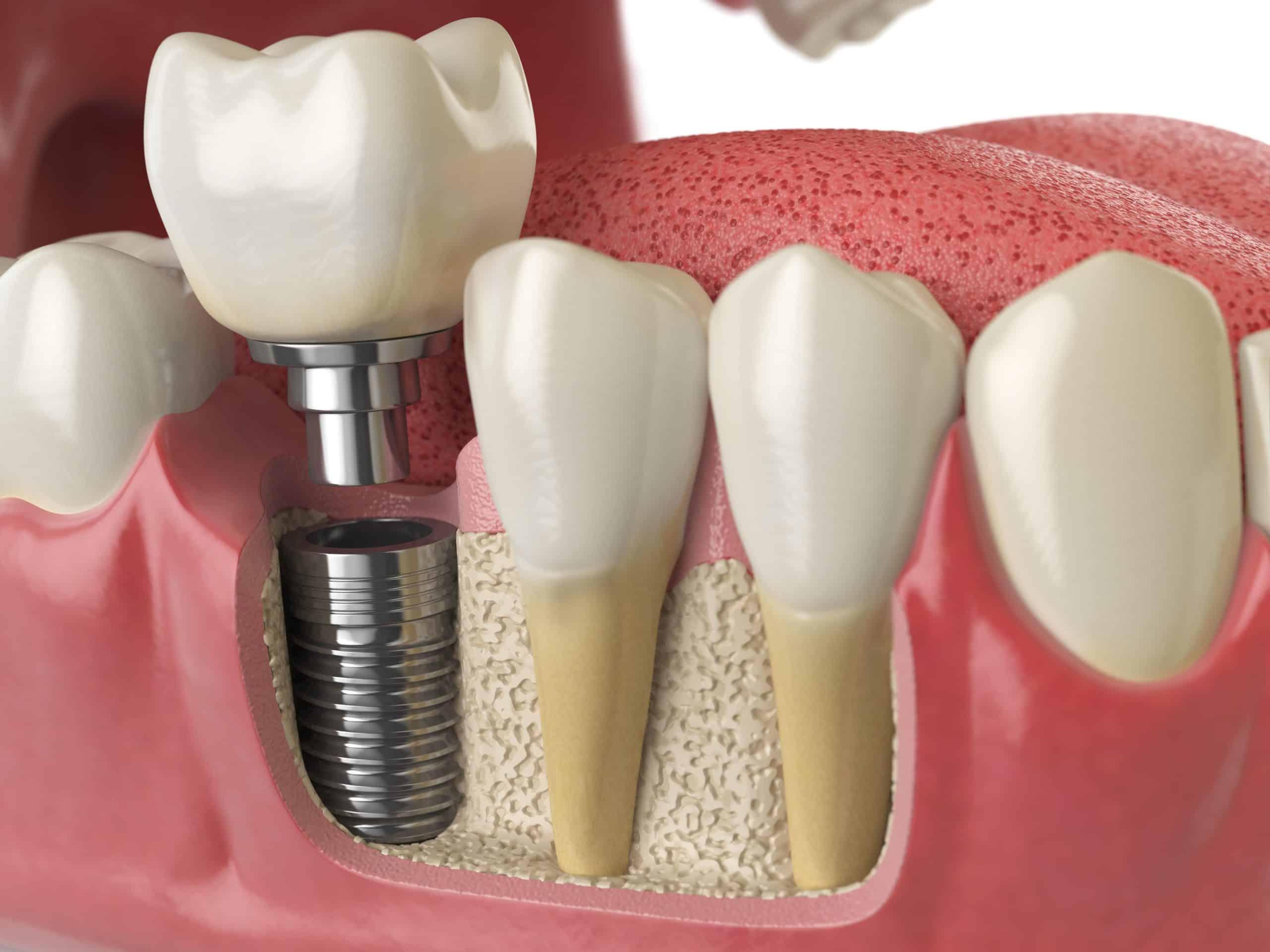 Understanding ⁢the​ Factors that Influence Dental ‌Implant Costs