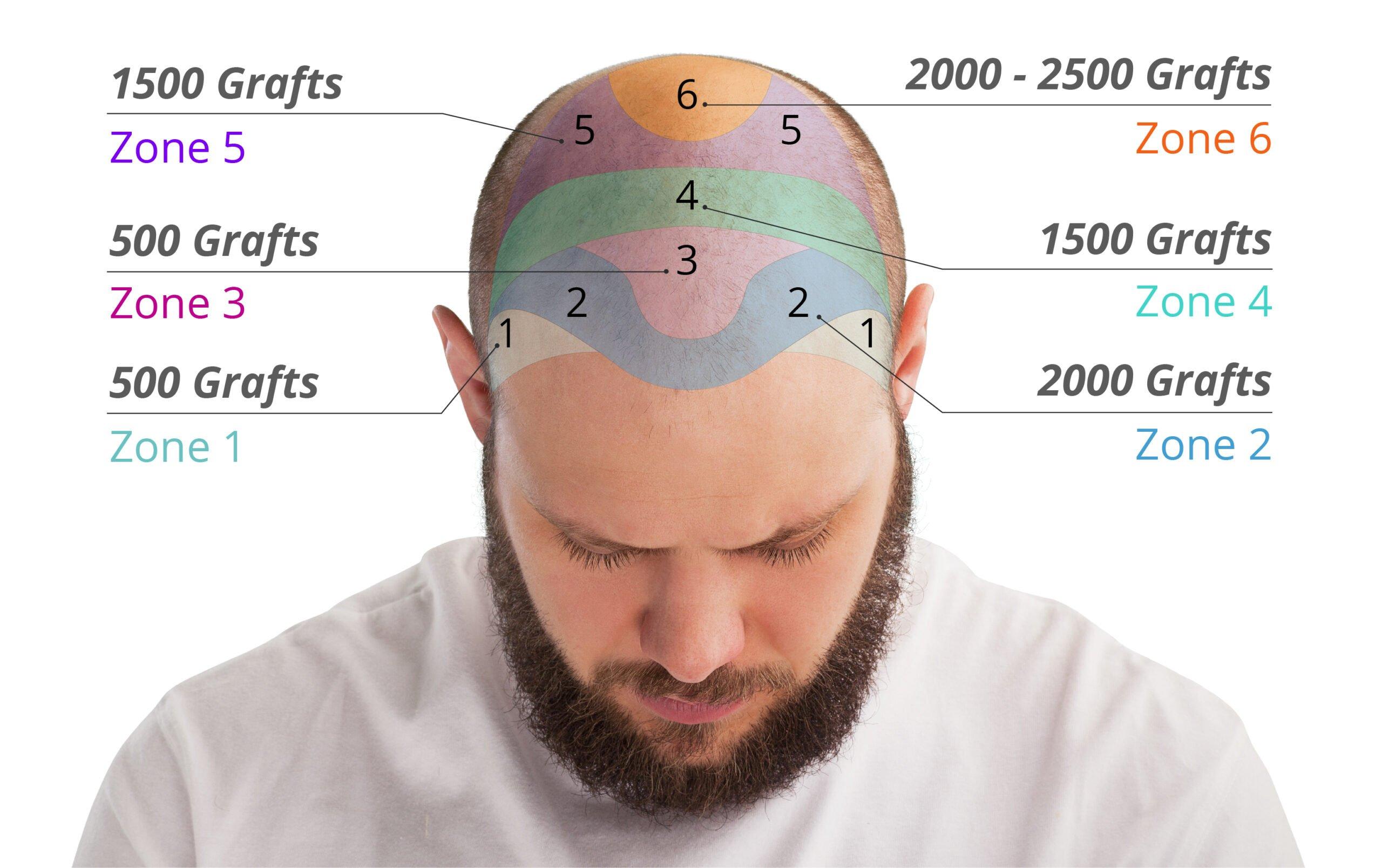 Understanding the Factors Influencing Hair Transplant‌ Costs