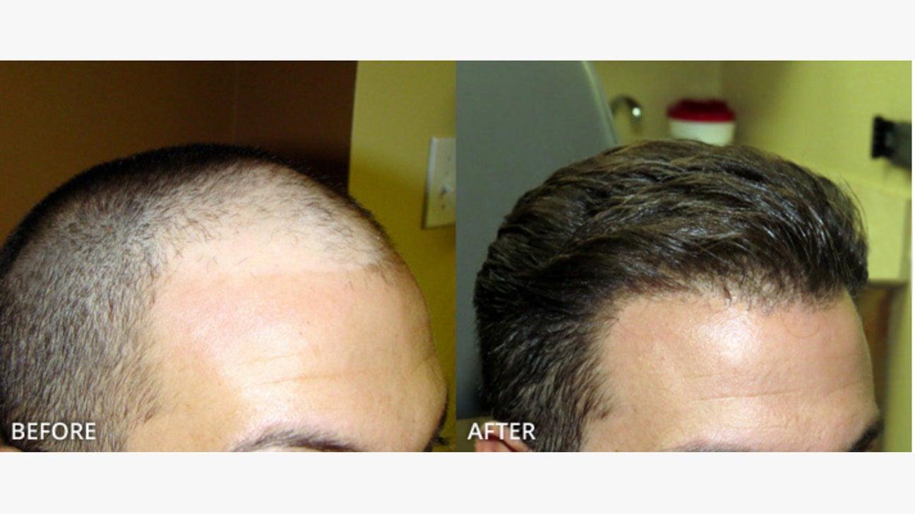 expert Recommendations:‍ Making the Right Choice for Lasting Results