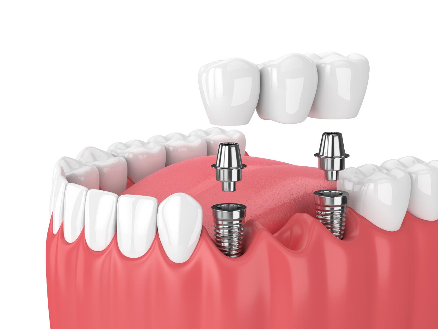 enhancing Oral Functionality‌ and Comfort